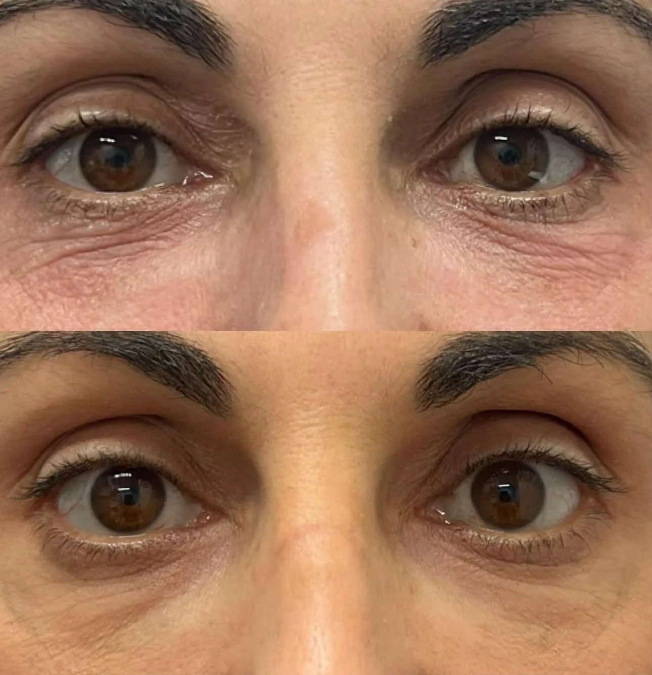 Rejuran under-eye treatment before and after results